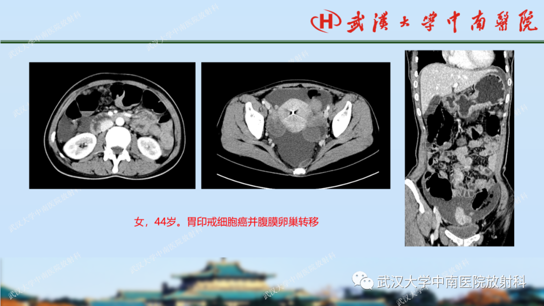【PPT】胃占位病变影像诊断分析-46
