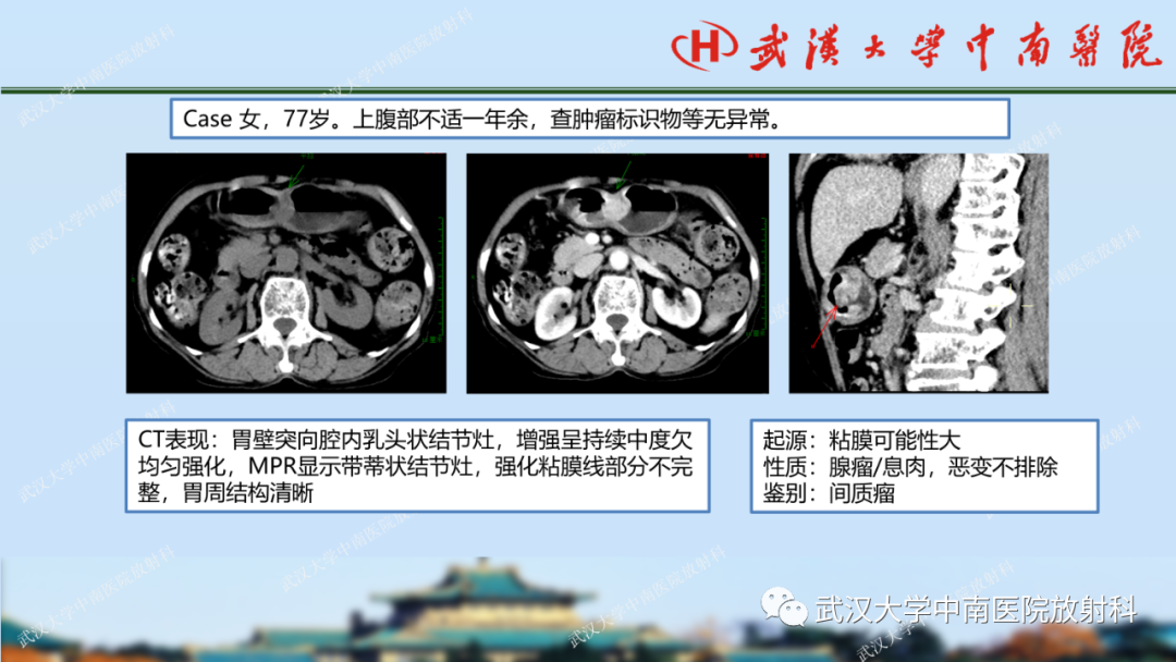 【PPT】胃占位病变影像诊断分析-50