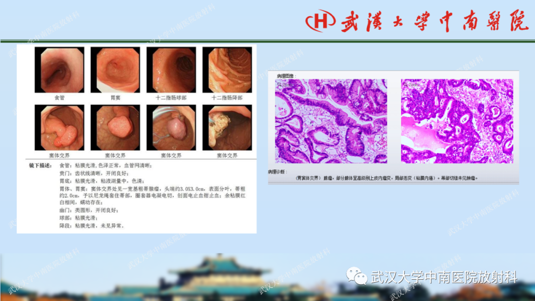 【PPT】胃占位病变影像诊断分析-51