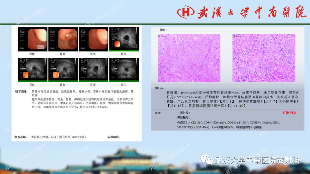 【PPT】胃占位病变影像诊断分析-55