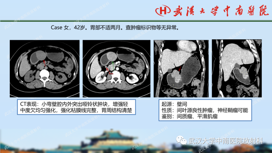 【PPT】胃占位病变影像诊断分析-54