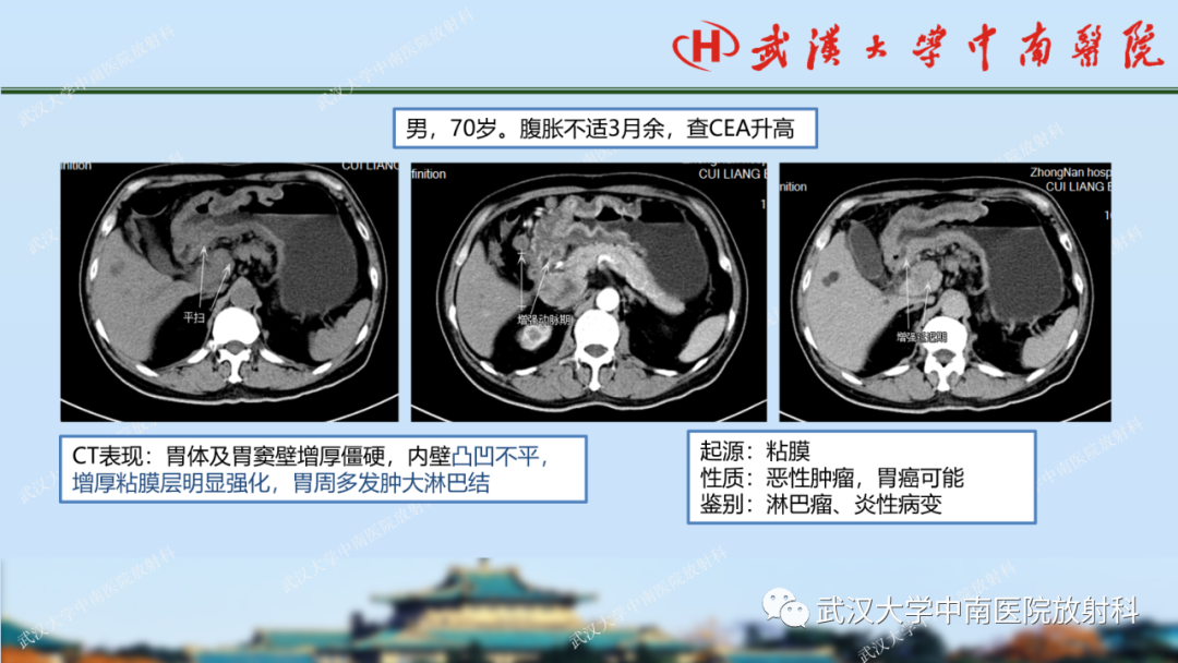 【PPT】胃占位病变影像诊断分析-58