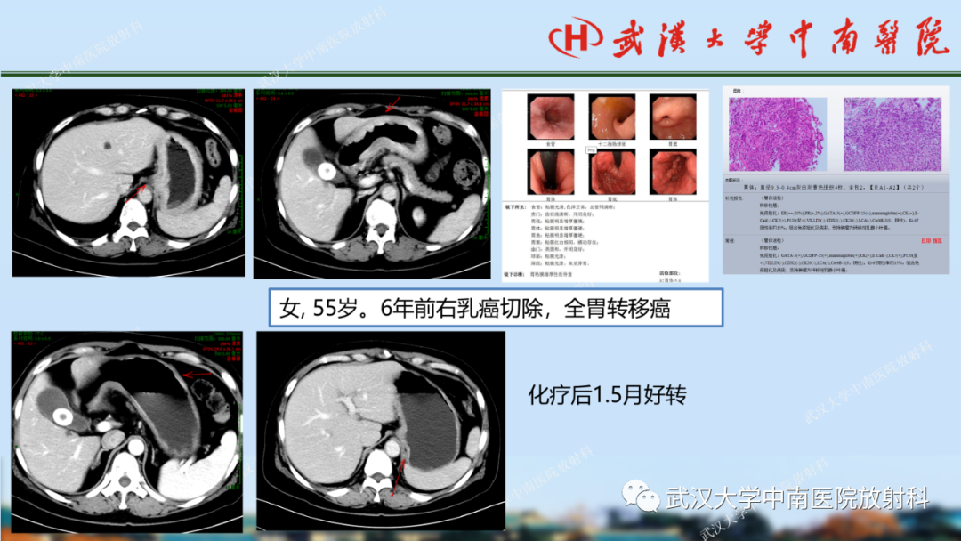 【PPT】胃占位病变影像诊断分析-61