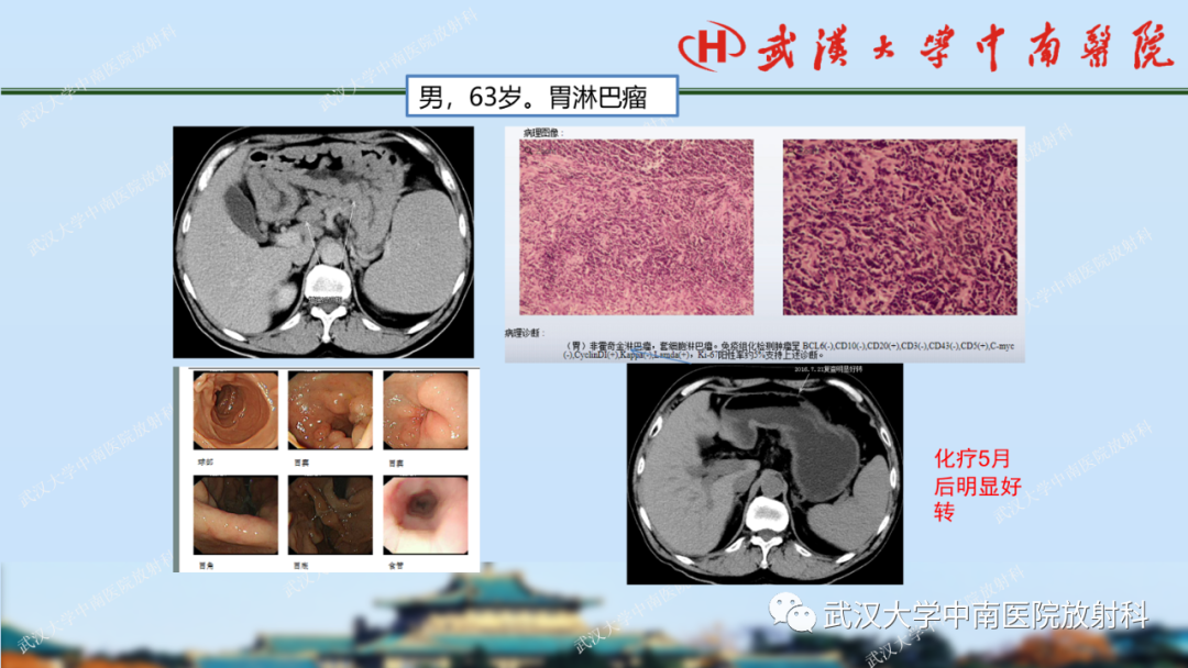 【PPT】胃占位病变影像诊断分析-60