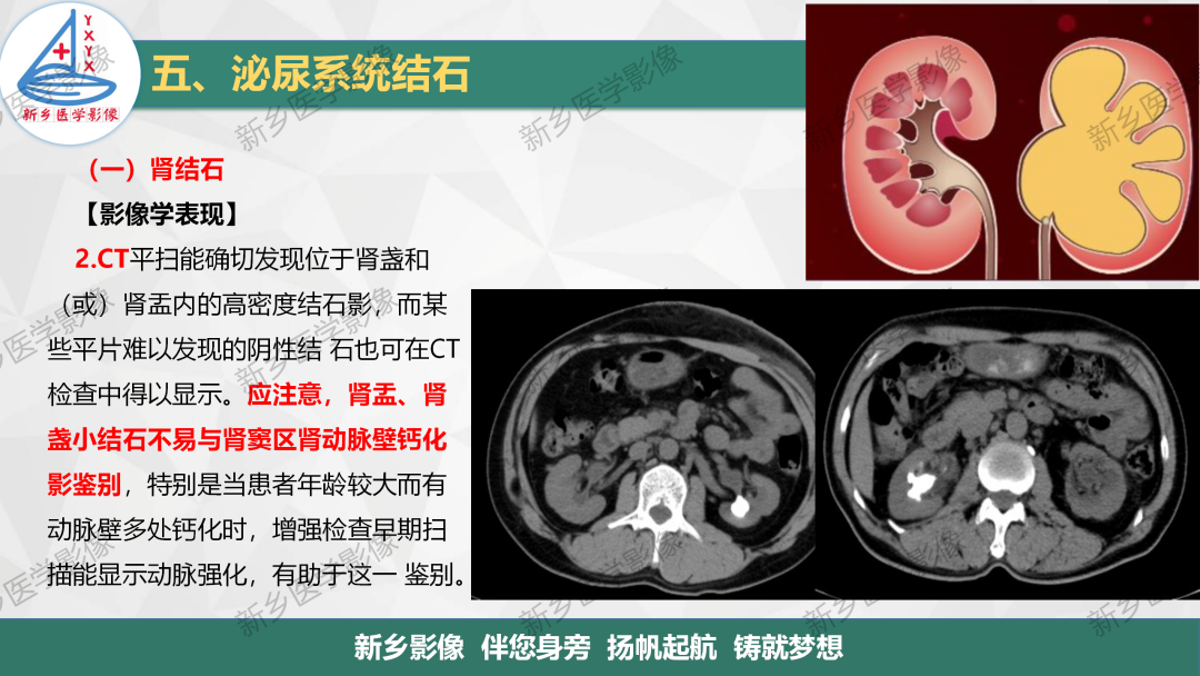 【PPT】泌尿系结石的影像表现及诊断注意事项-7