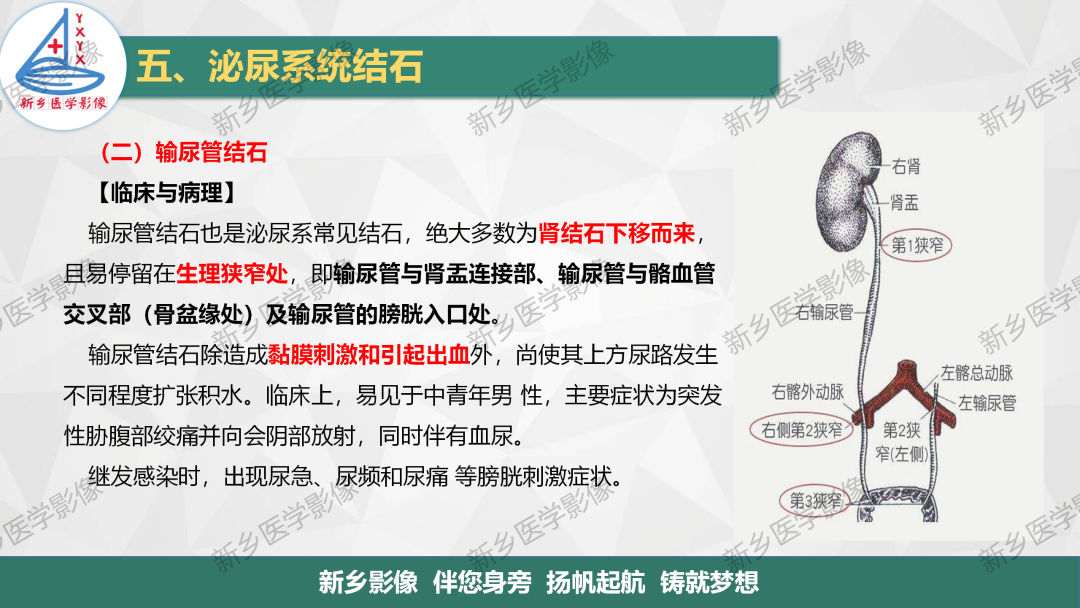 【PPT】泌尿系结石的影像表现及诊断注意事项-9
