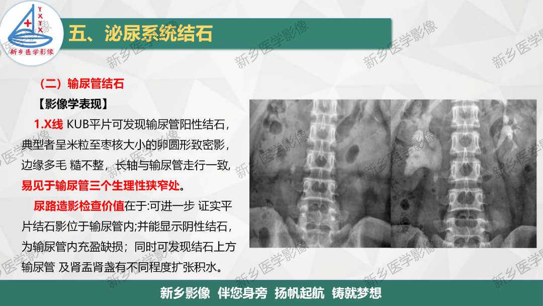 【PPT】泌尿系结石的影像表现及诊断注意事项-10