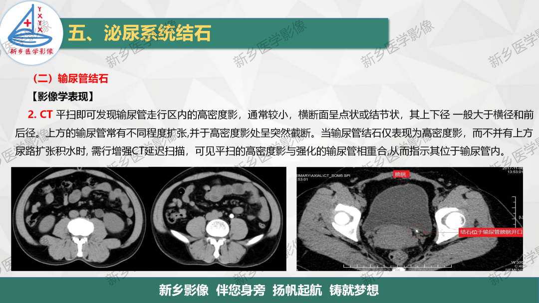【PPT】泌尿系结石的影像表现及诊断注意事项-11
