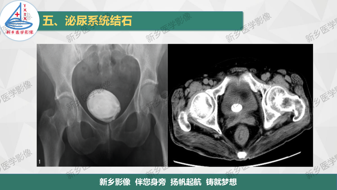 【PPT】泌尿系结石的影像表现及诊断注意事项-14