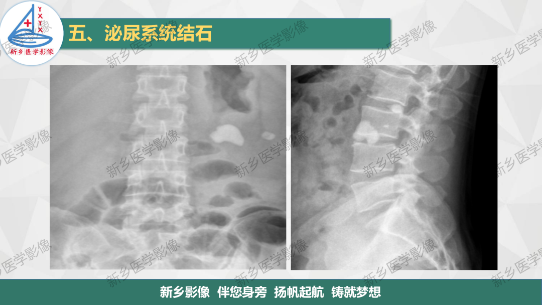 【PPT】泌尿系结石的影像表现及诊断注意事项-3