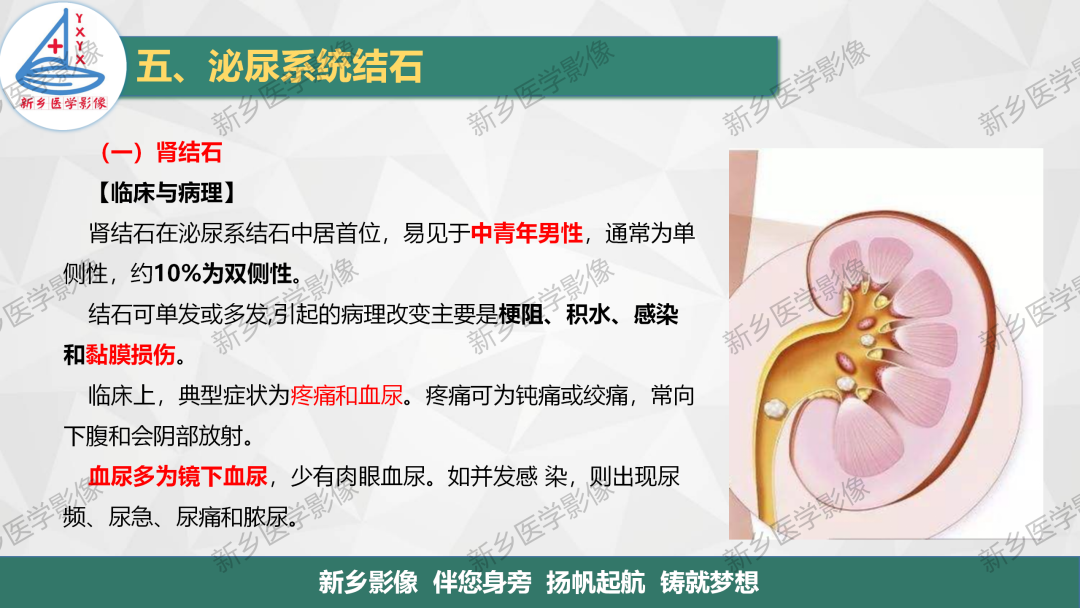 【PPT】泌尿系结石的影像表现及诊断注意事项-1