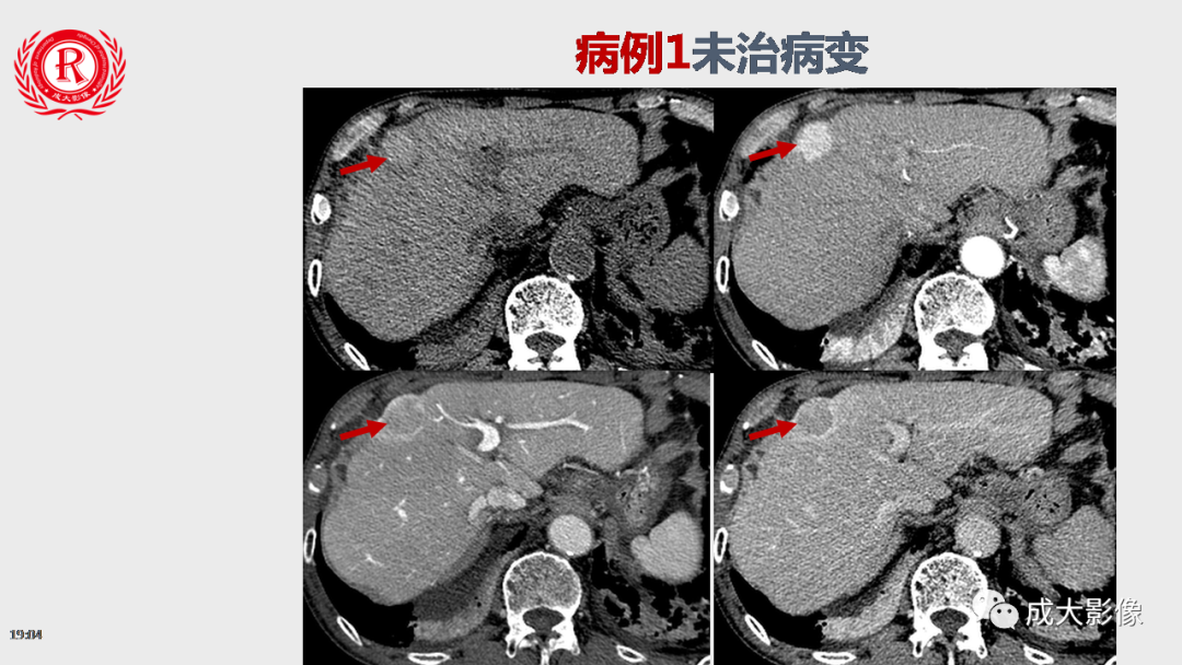 【PPT】LI-RADS结构化报告实例应用-19