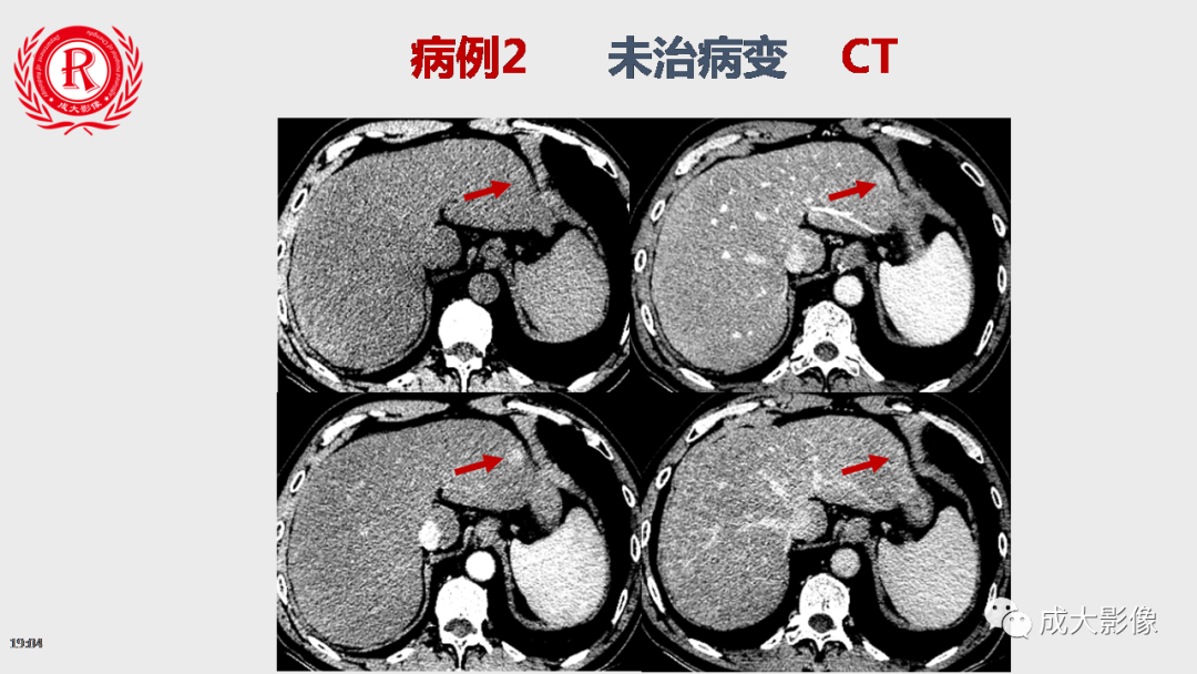 【PPT】LI-RADS结构化报告实例应用-25