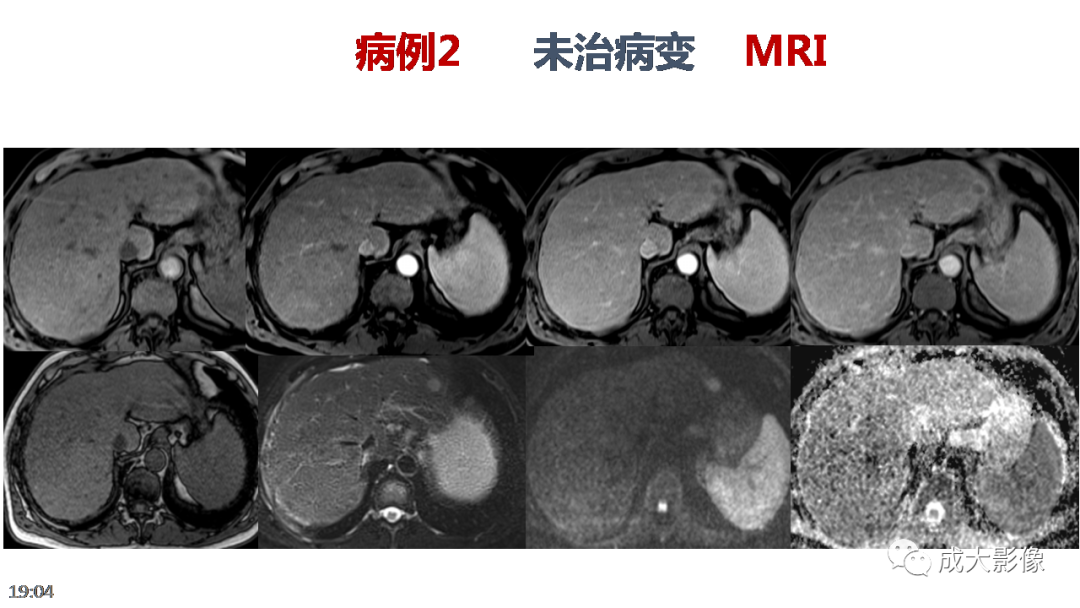 【PPT】LI-RADS结构化报告实例应用-28