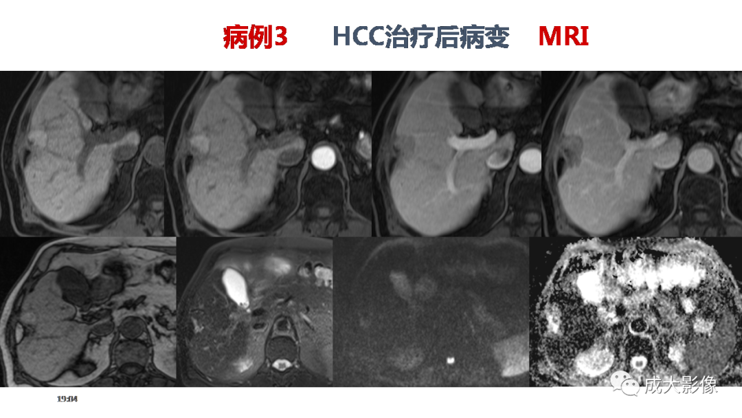 【PPT】LI-RADS结构化报告实例应用-32