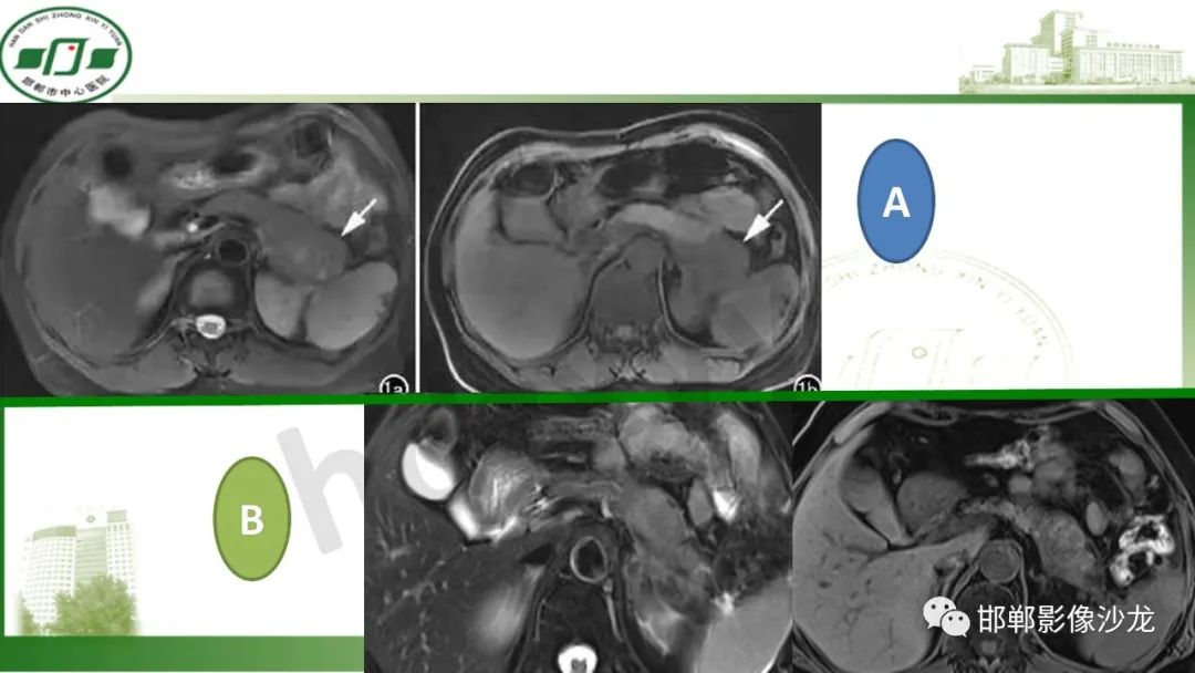 【PPT】肿块性胰腺炎-2