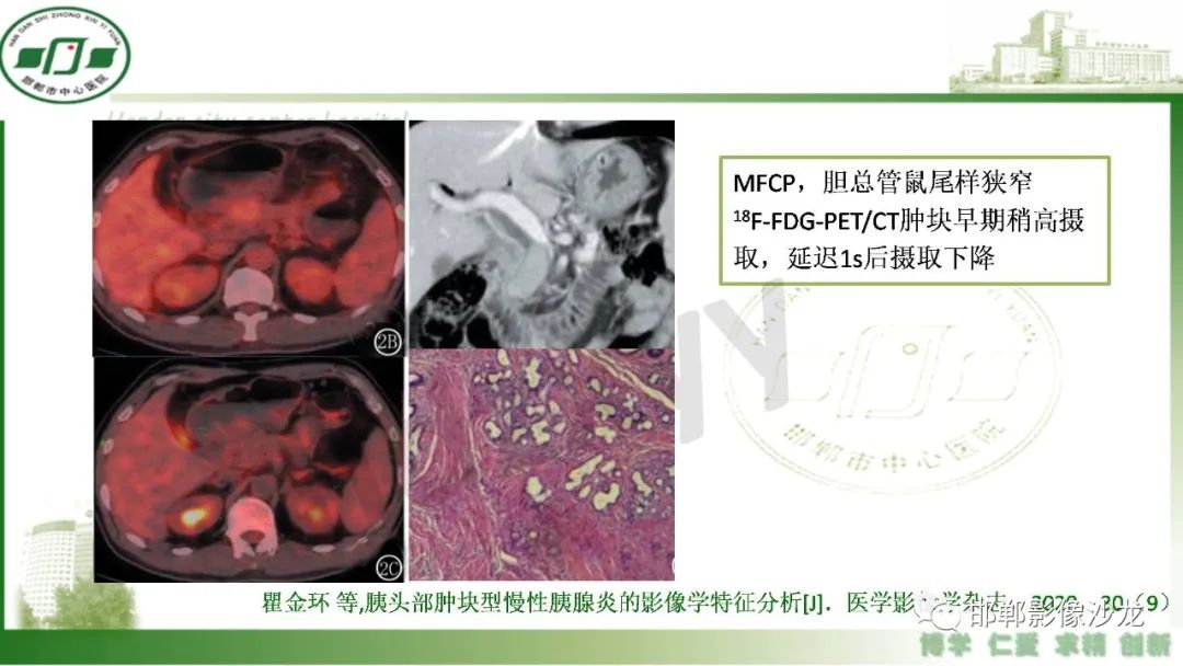 【PPT】肿块性胰腺炎-10