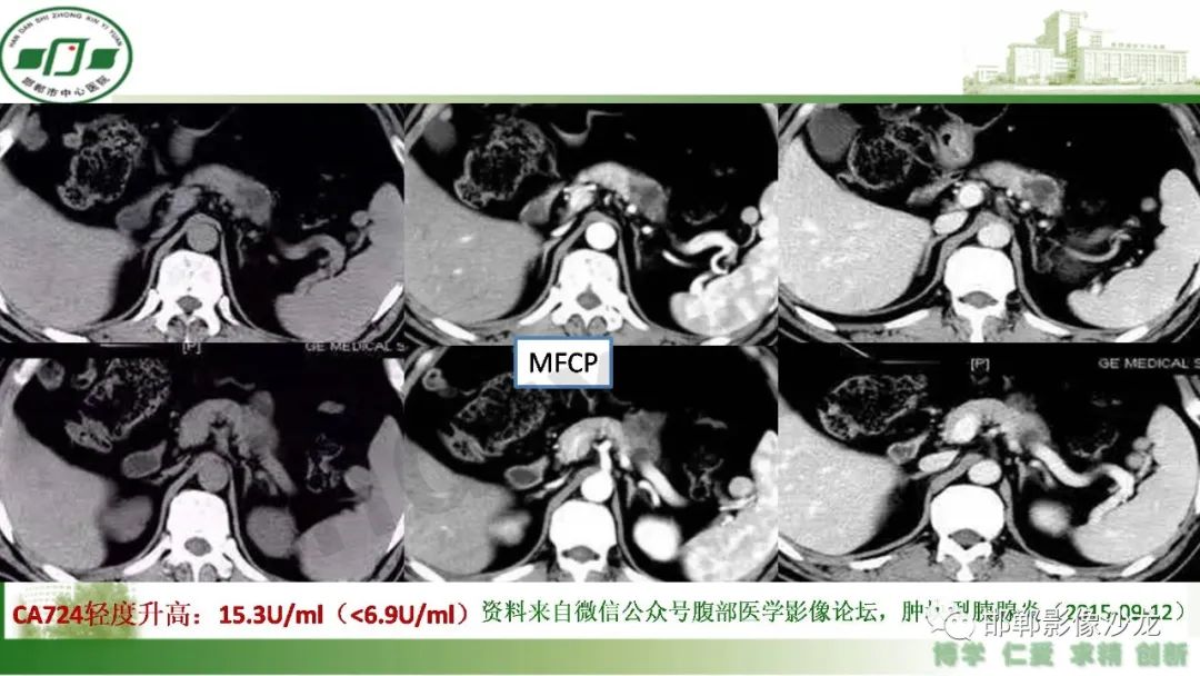 【PPT】肿块性胰腺炎-12