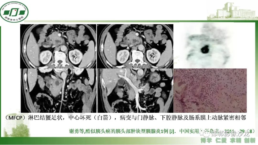 【PPT】肿块性胰腺炎-11
