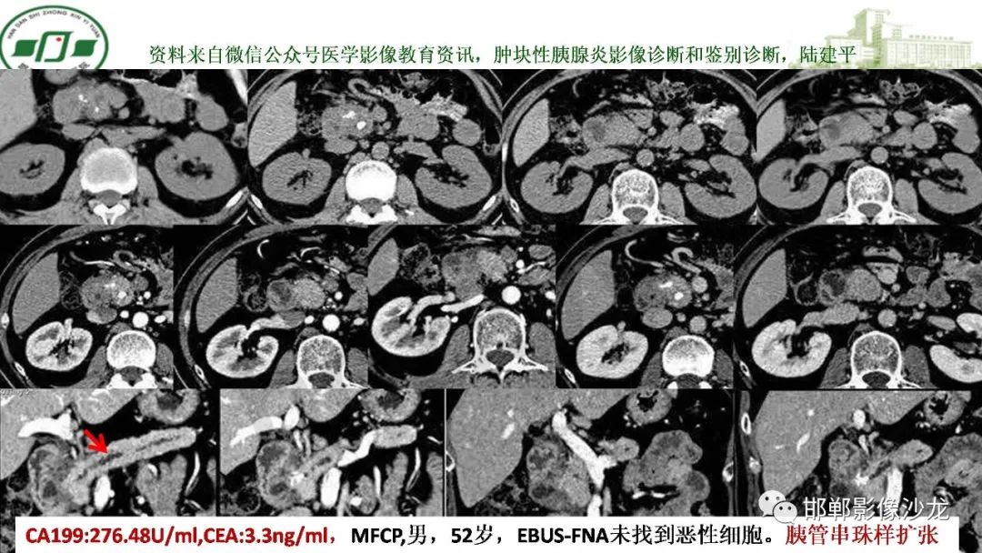 【PPT】肿块性胰腺炎-13