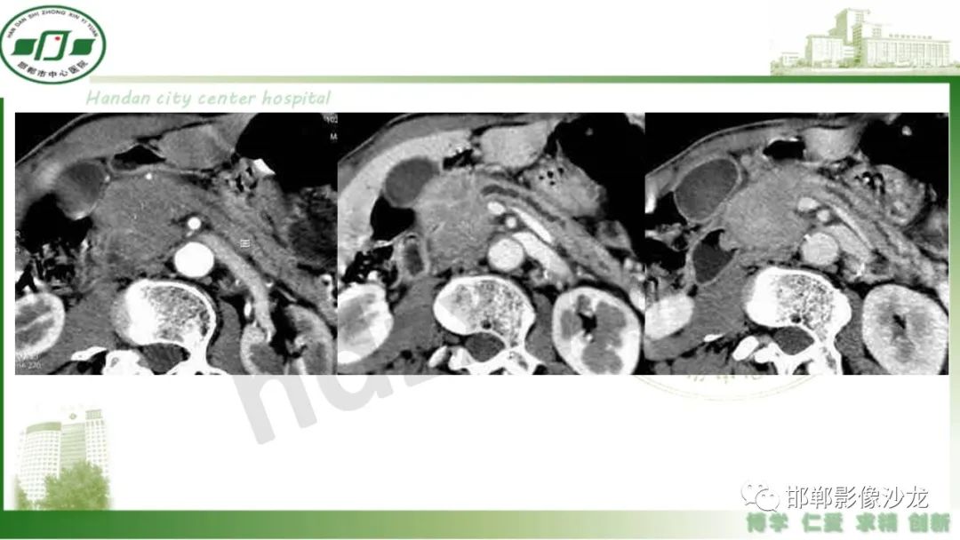 【PPT】肿块性胰腺炎-14