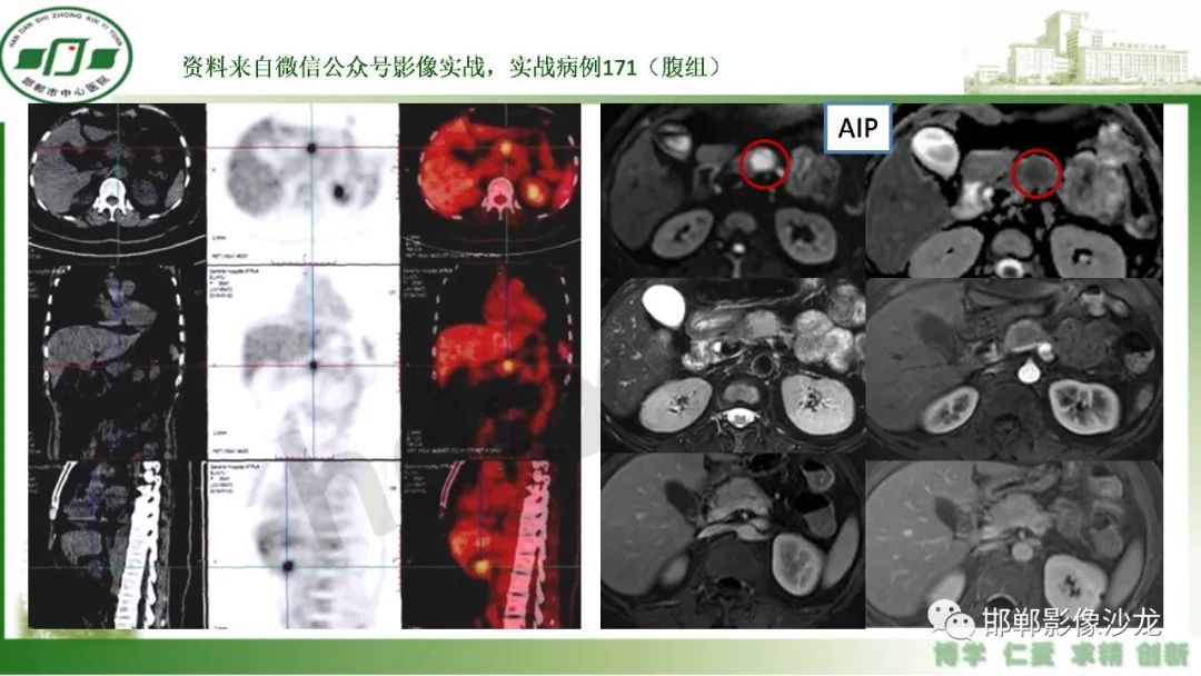 【PPT】肿块性胰腺炎-18