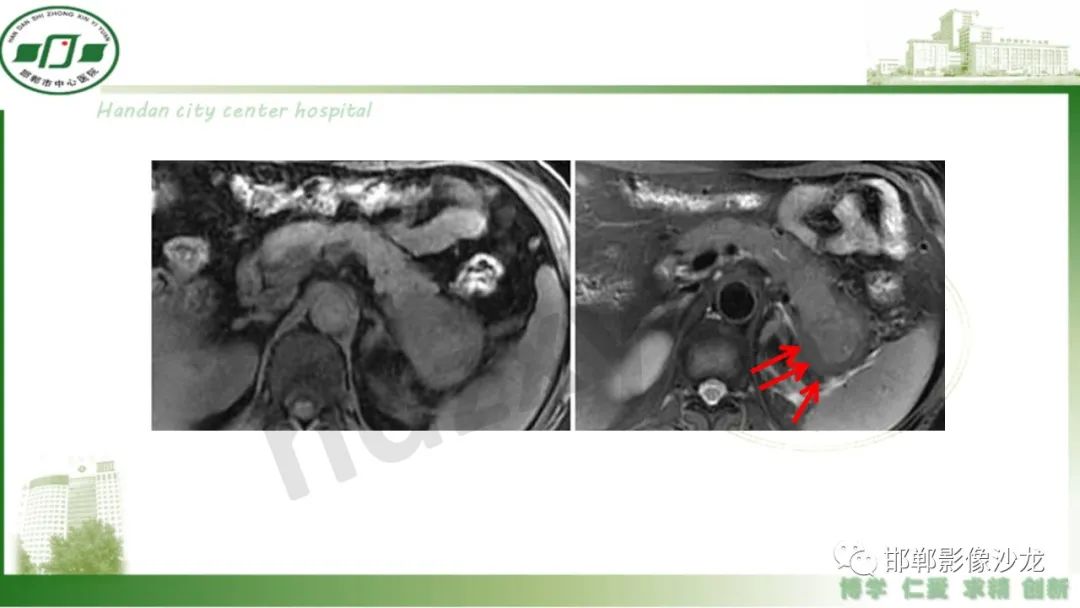 【PPT】肿块性胰腺炎-19