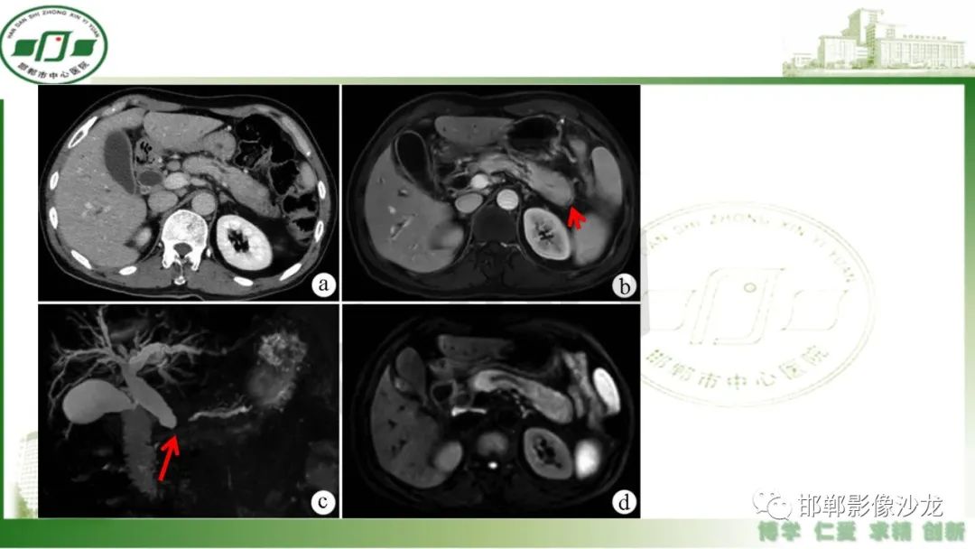 【PPT】肿块性胰腺炎-20