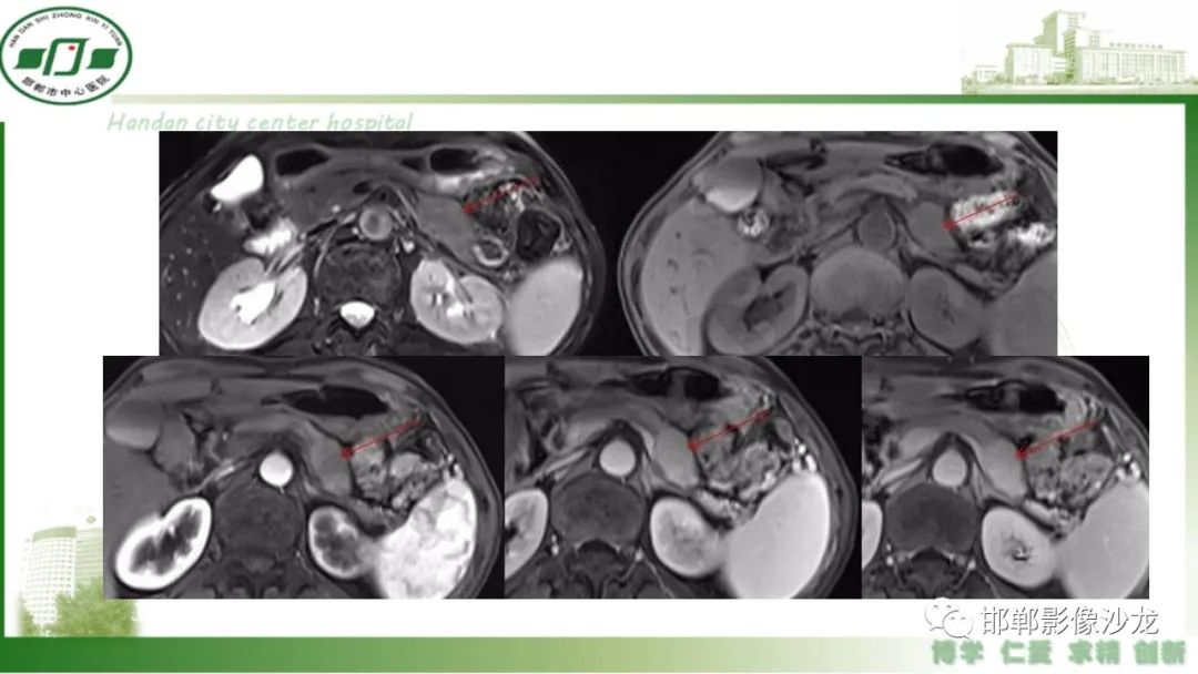 【PPT】肿块性胰腺炎-21