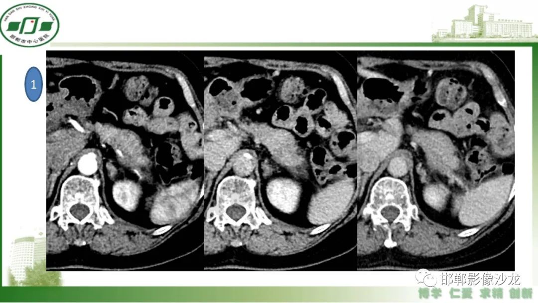 【PPT】肿块性胰腺炎-22