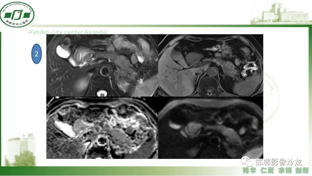 【PPT】肿块性胰腺炎-23