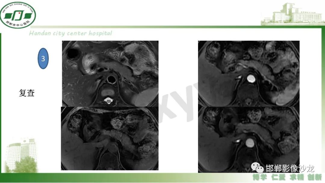 【PPT】肿块性胰腺炎-24