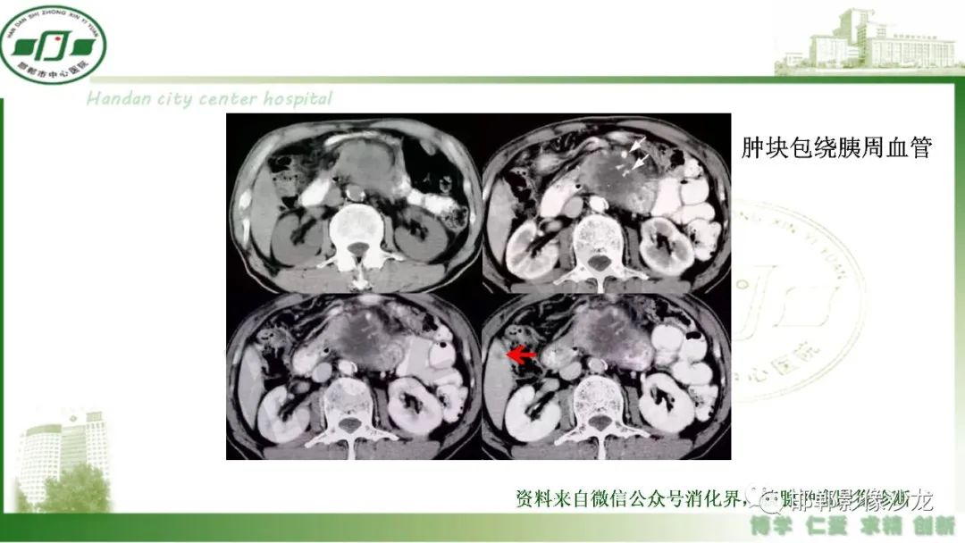 【PPT】肿块性胰腺炎-27