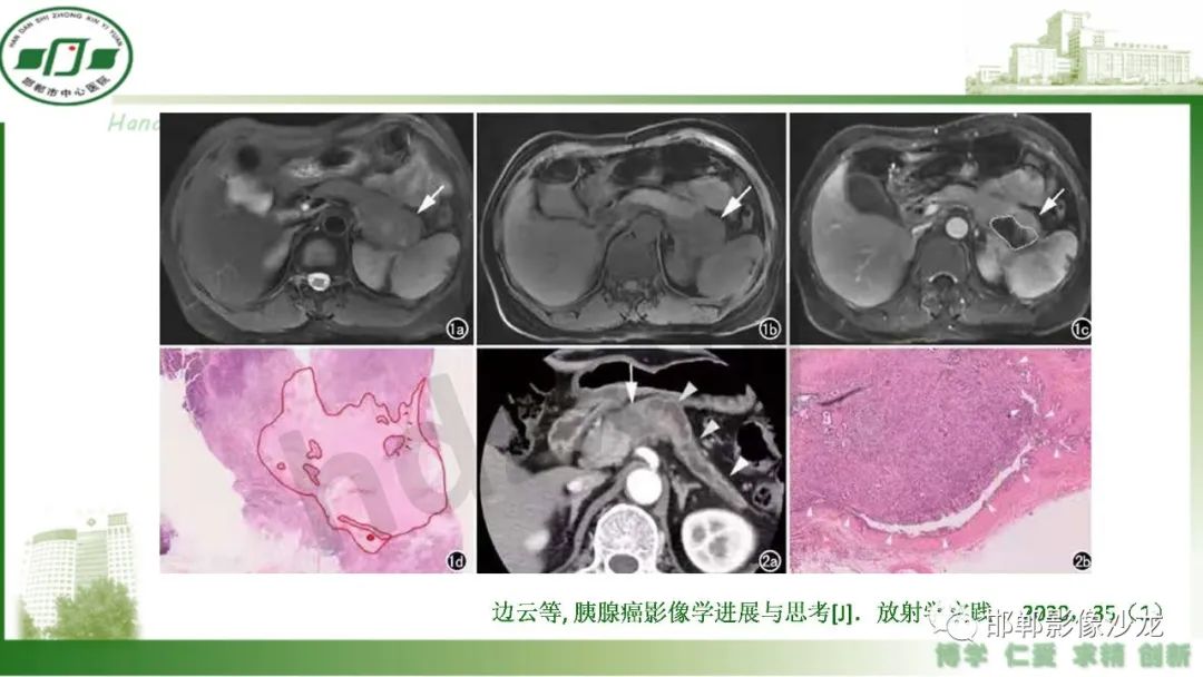 【PPT】肿块性胰腺炎-28