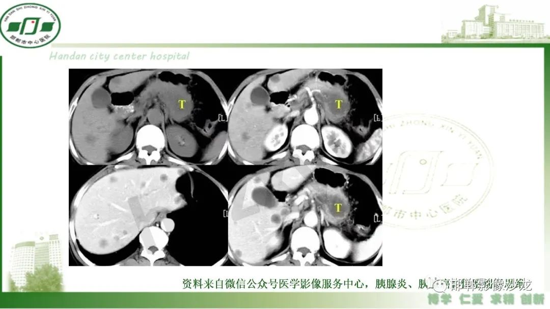 【PPT】肿块性胰腺炎-29
