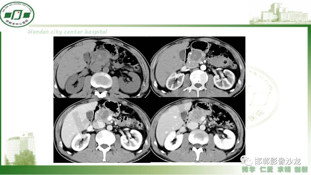 【PPT】肿块性胰腺炎-31