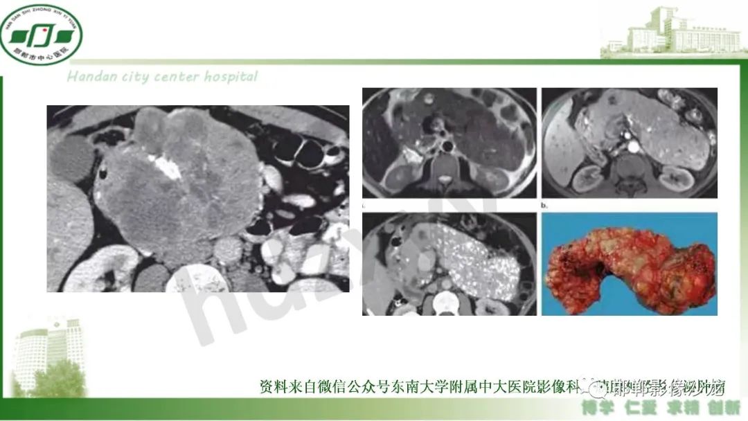 【PPT】肿块性胰腺炎-33