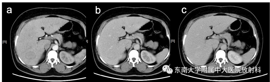 【PPT】肝细胞腺瘤-1