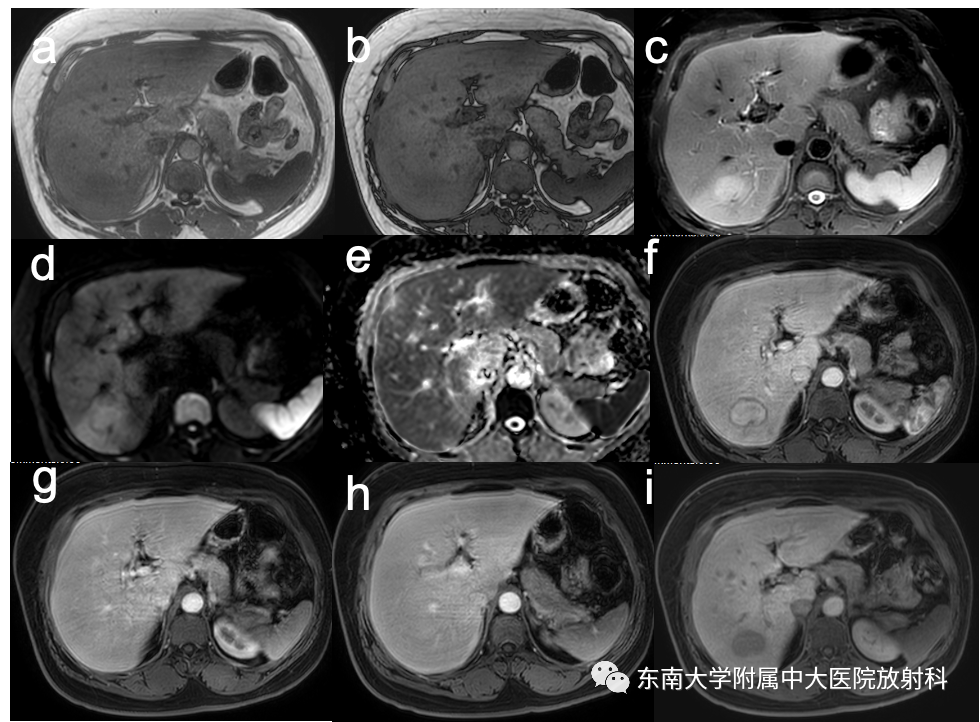 【PPT】肝细胞腺瘤-2