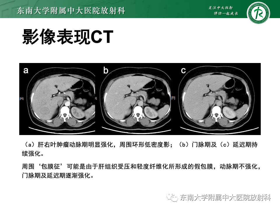 【PPT】肝细胞腺瘤-4