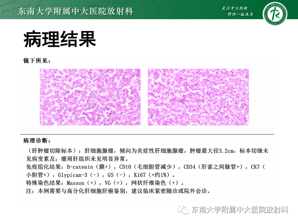 【PPT】肝细胞腺瘤-6