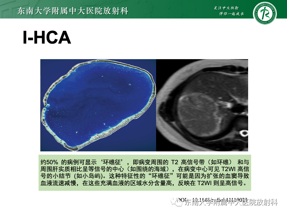 【PPT】肝细胞腺瘤-12