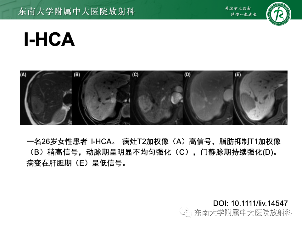 【PPT】肝细胞腺瘤-13