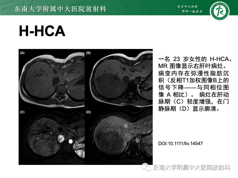 【PPT】肝细胞腺瘤-16