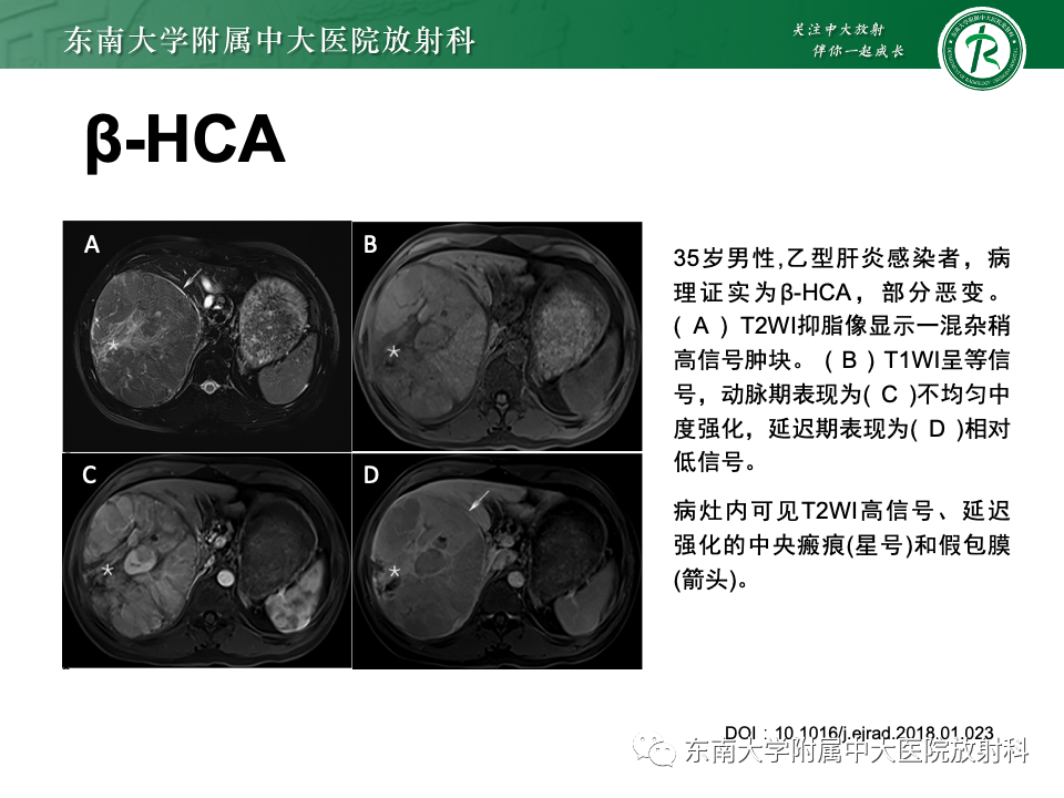 【PPT】肝细胞腺瘤-19