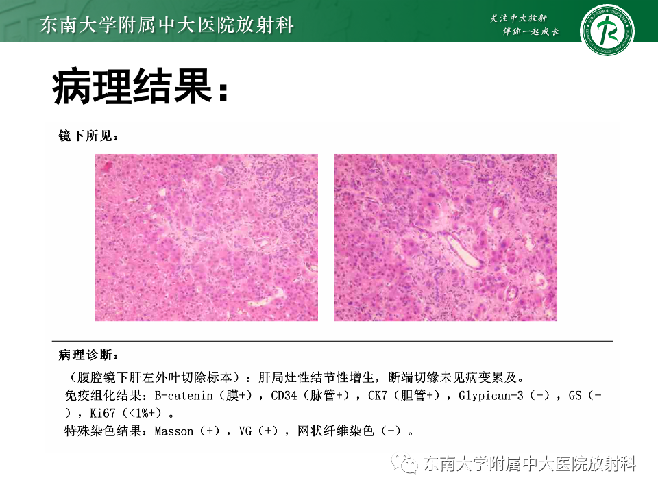 【PPT】肝细胞腺瘤-22