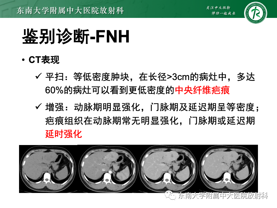 【PPT】肝细胞腺瘤-25