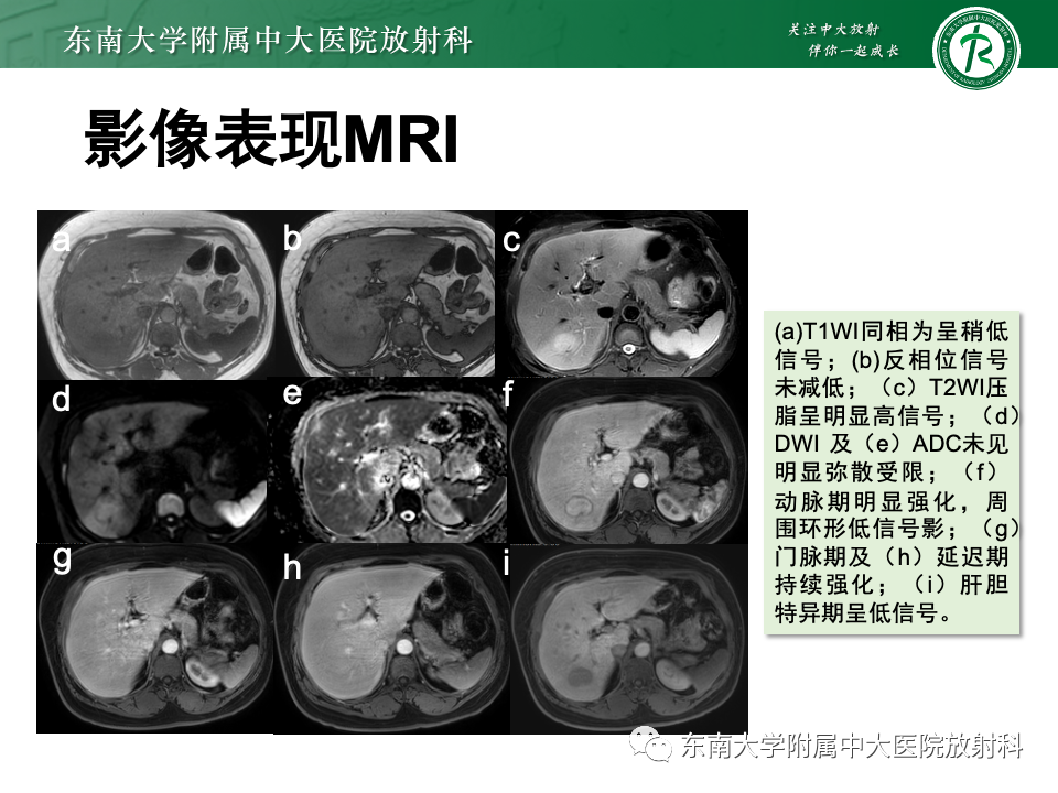 【PPT】肝细胞腺瘤-1