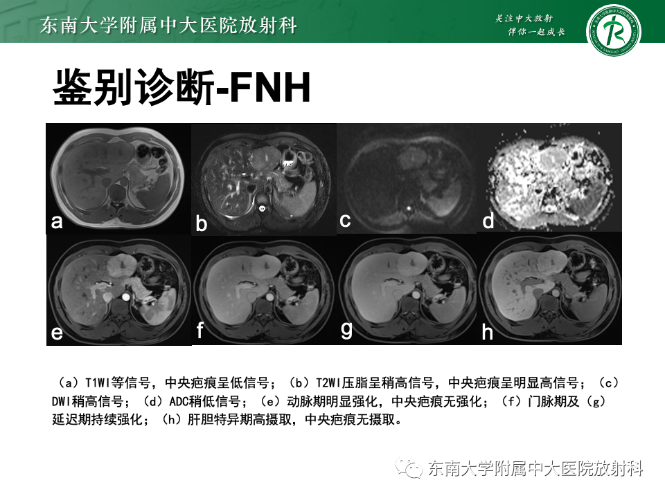 【PPT】肝细胞腺瘤-5