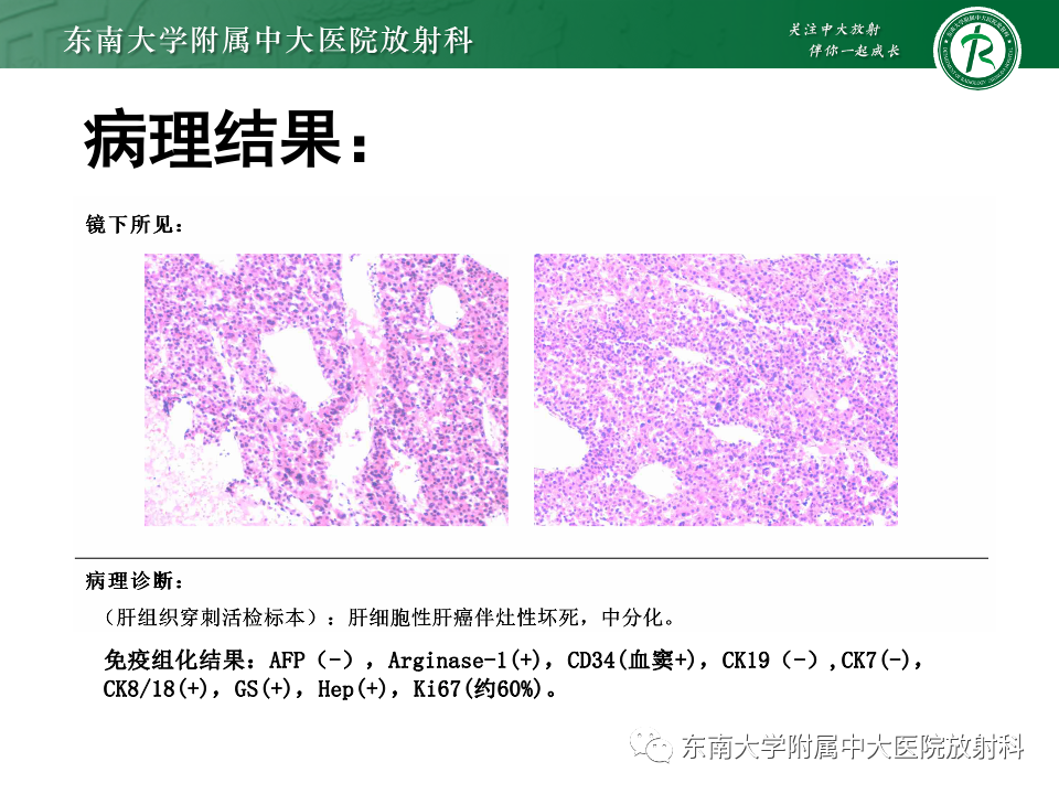 【PPT】肝细胞腺瘤-6